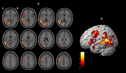 Al interpretar el sarcasmo, múltiples regiones cerebrales con conexiones neuronales relacionadas con habilidades sociales se activan simultáneamente.